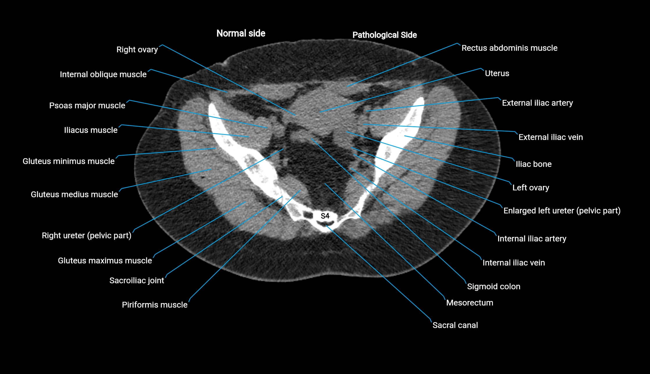 CT KUB axial cross sectional anatomy  radiology image -img-00201-00134.webp